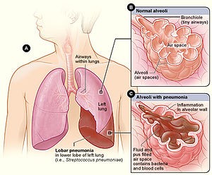 Lobe pneumonia &#8211; symptoms, diagnosis, treatment