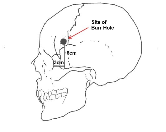 Lobotomy (prefrontal leukotomy) &#8211; what it was about, side effects