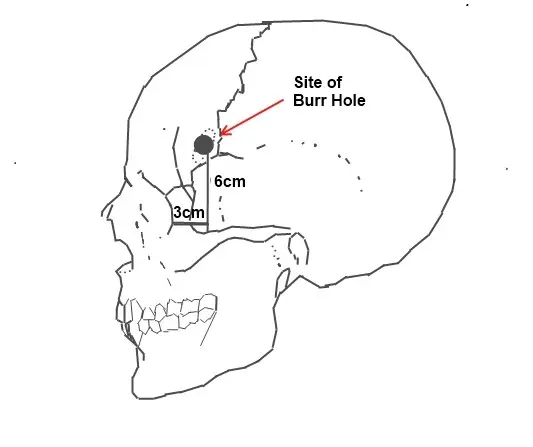 Lobotomy (prefrontal leukotomy) &#8211; what it was about, side effects