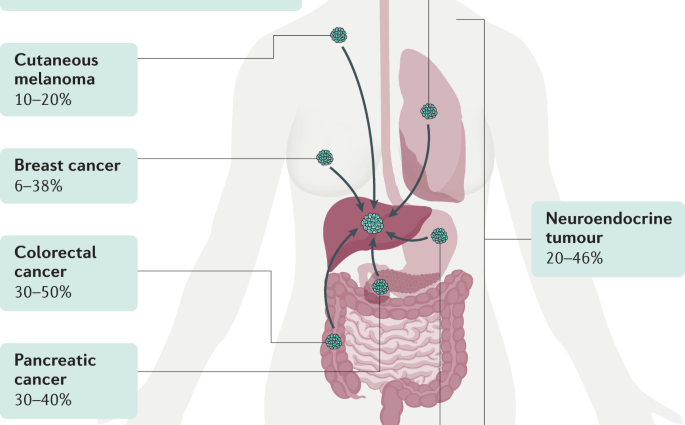 Location of metastases in liver cancer