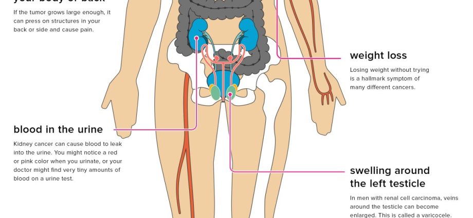 Location of renal cancer metastases