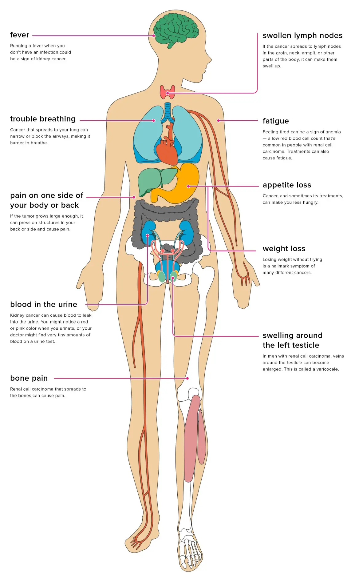 Location of renal cancer metastases