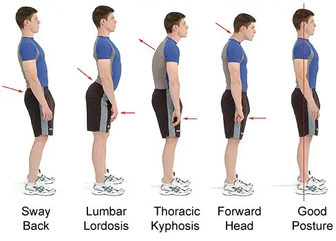 Lordosis &#8211; types, causes, symptoms. Prophylaxis of lordosis