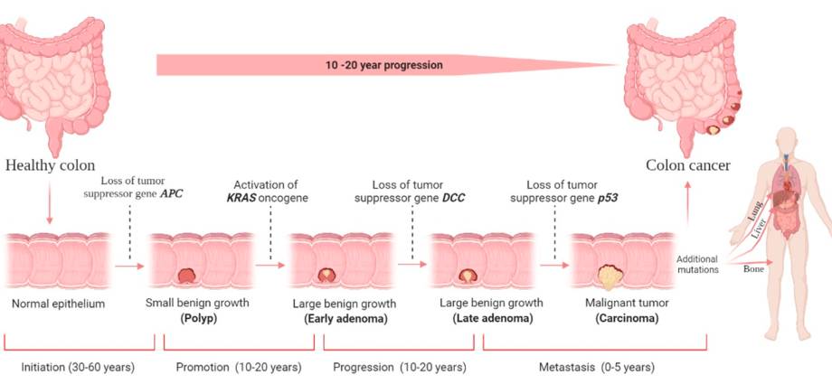 Low calcium levels can contribute to the development of colon cancer