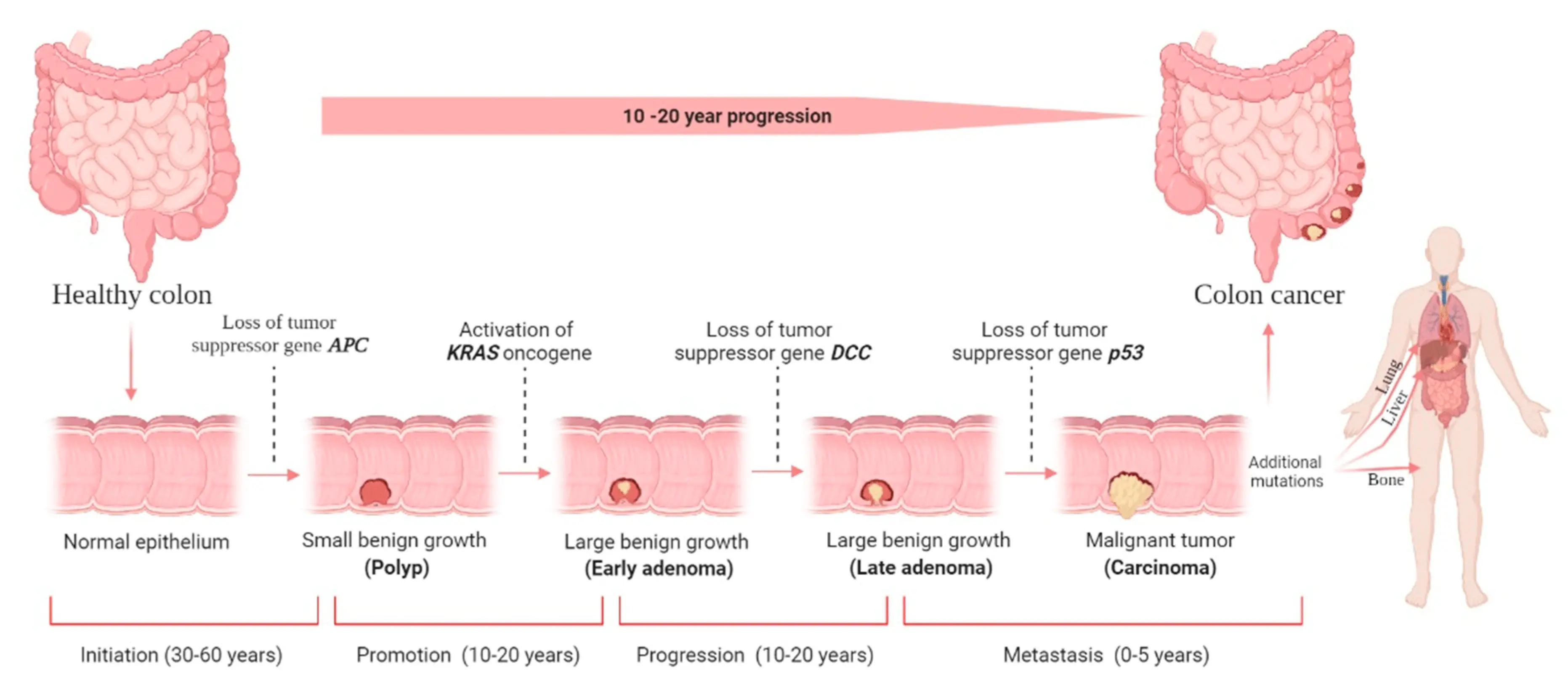 Low calcium levels can contribute to the development of colon cancer