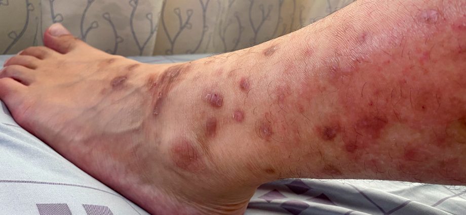 Lower leg eczema &#8211; causes, symptoms, treatment