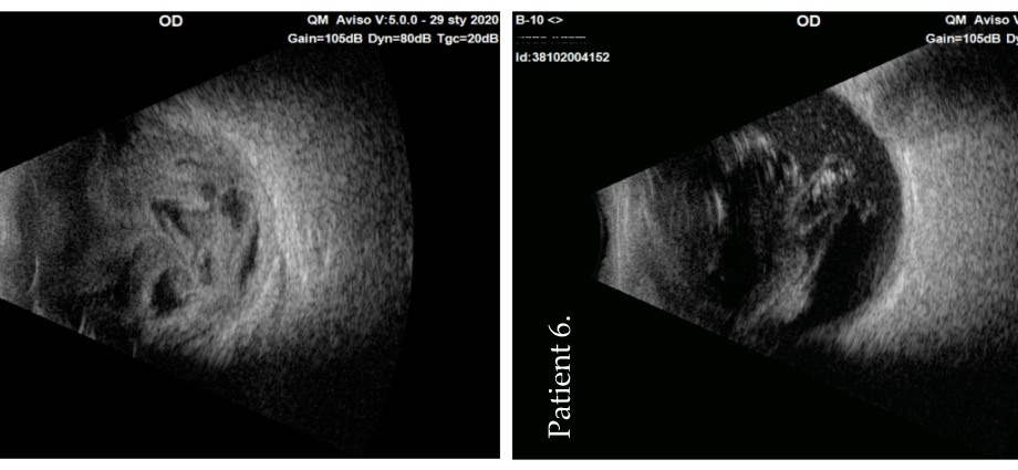 Lublin: patients after cataract surgery infected with staphylococcus