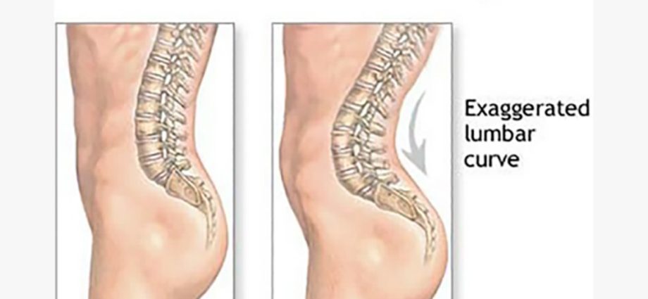 Lumbar lordosis &#8211; causes, symptoms and treatment