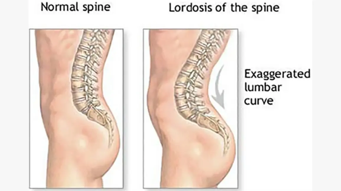 Lumbar lordosis &#8211; causes, symptoms and treatment