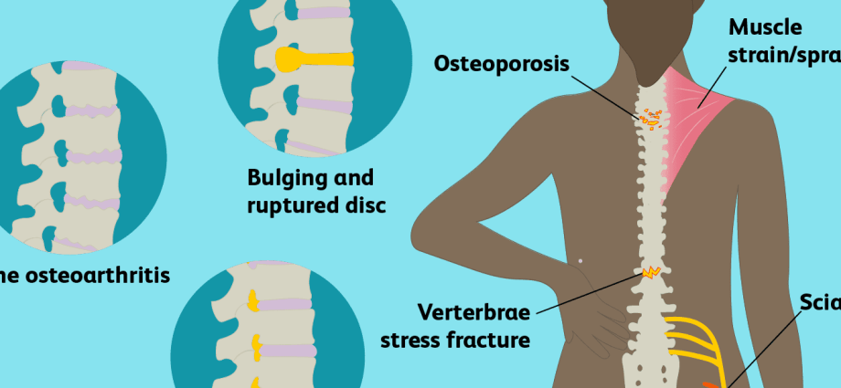 כאבים בעמוד השדרה המותני - ממה זה יכול לנבוע? גורמים, טיפול, טיפולים ותרגילים לעמוד השדרה המותני