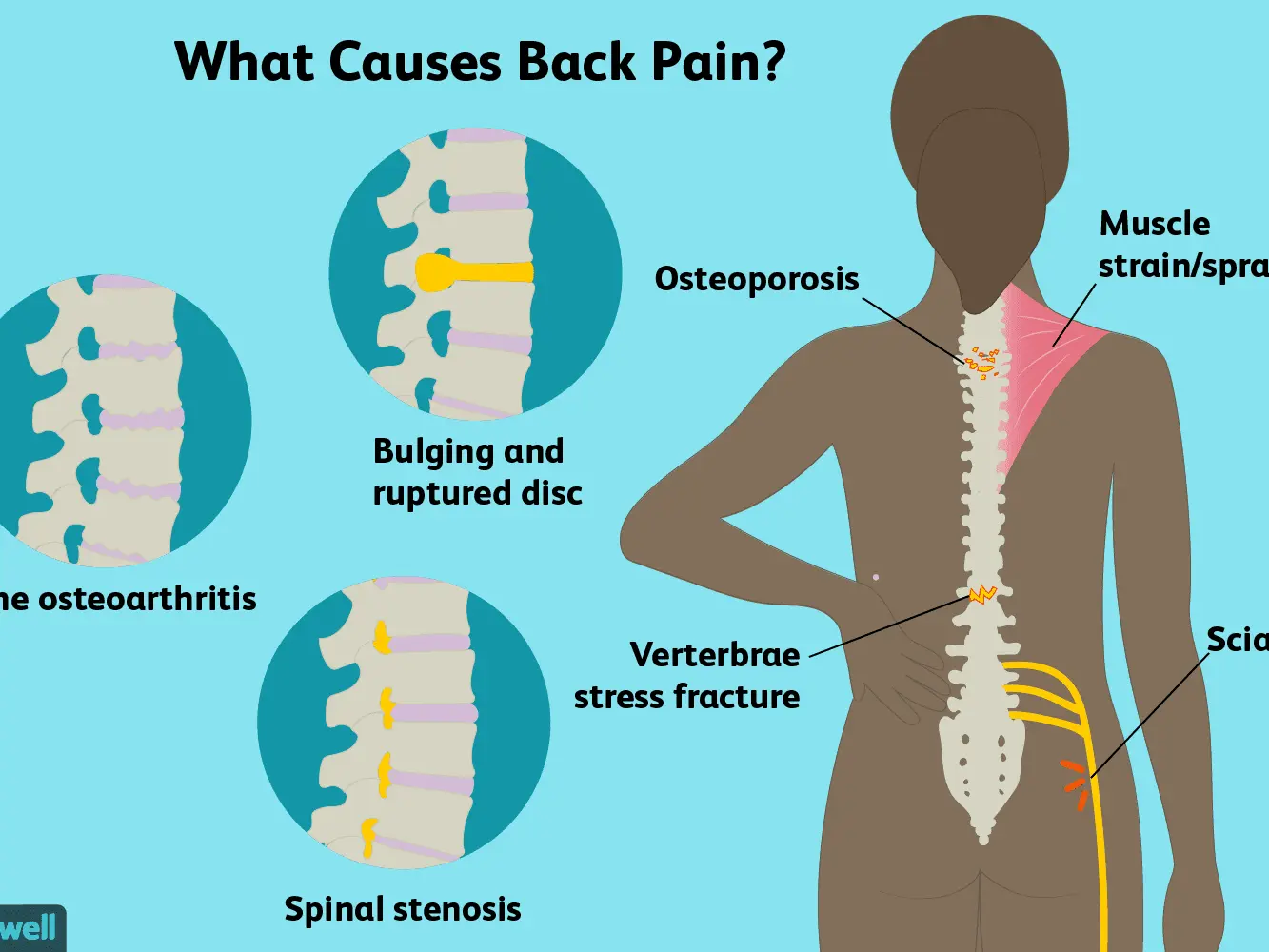 Lumbar spine pain &#8211; what can it result from? Causes, treatment, treatments and exercises for the lumbar spine