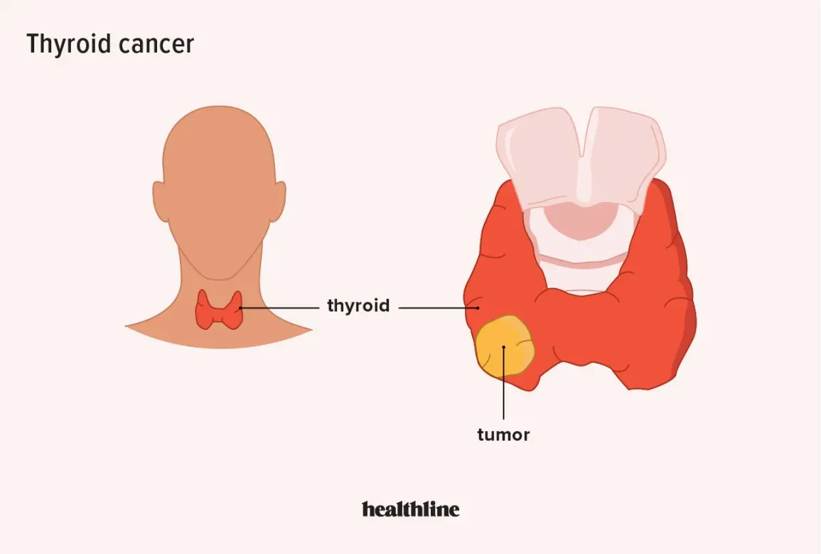 Lump in the neck &#8211; causes, neoplasms, thyroid, treatment