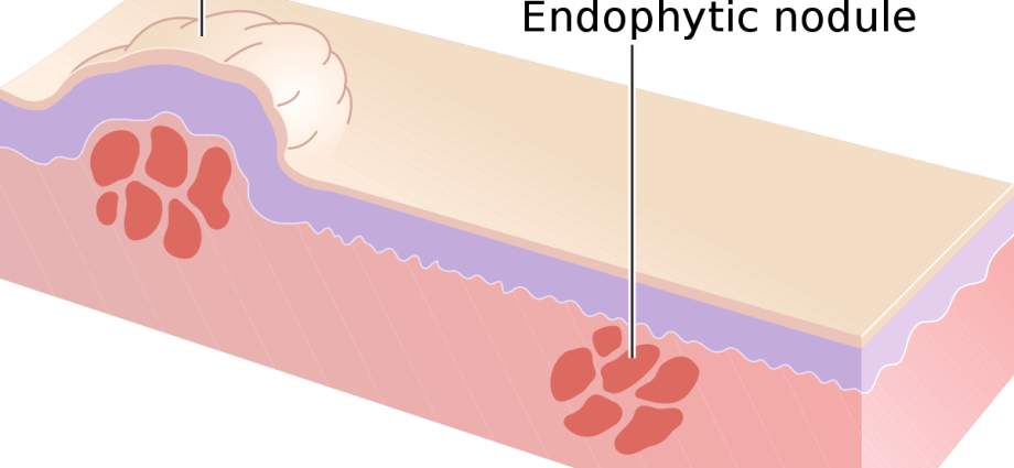 Lump (nodulus) &#8211; what is it?