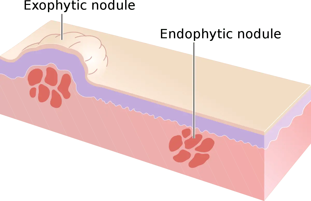 Lump (nodulus) &#8211; what is it?