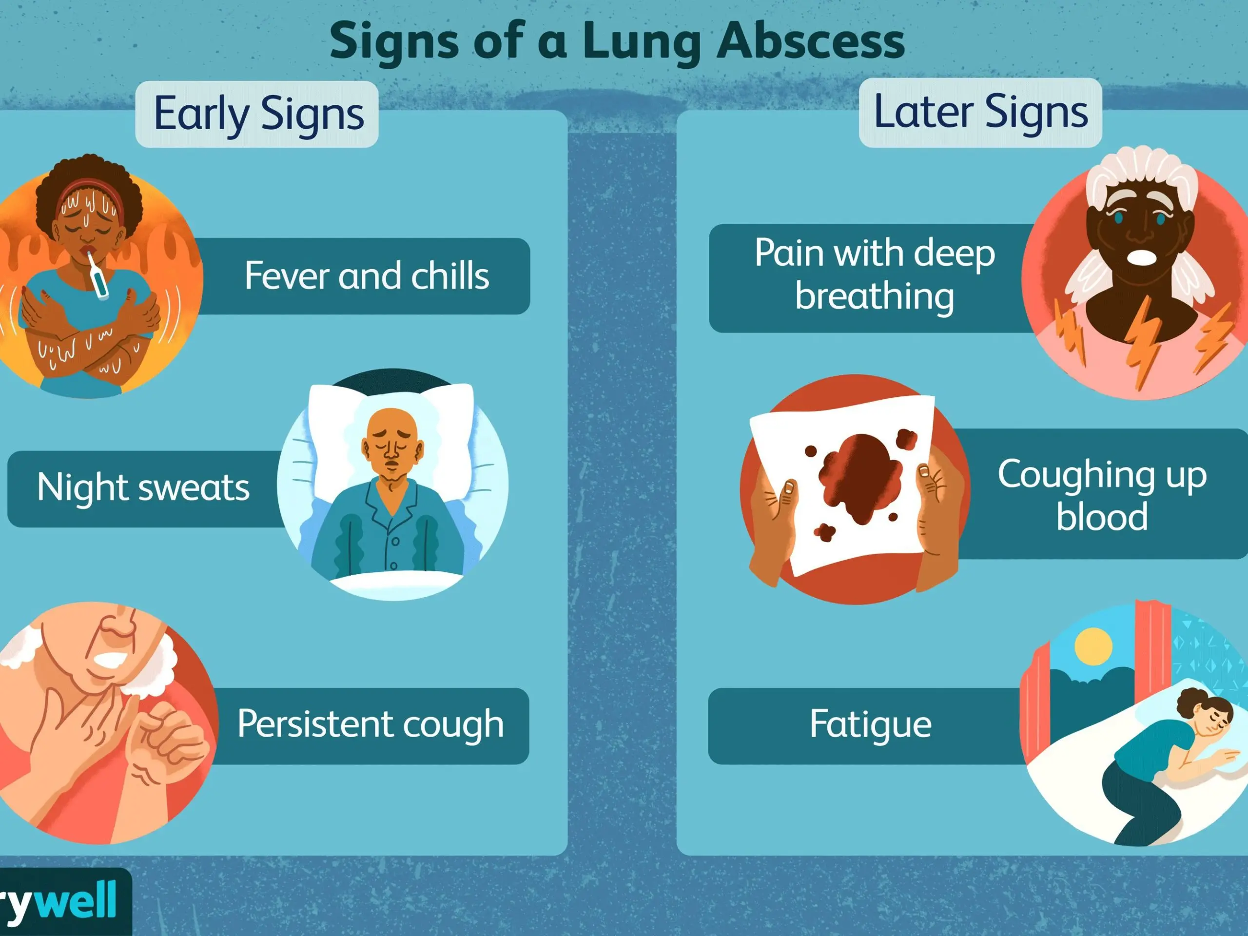 Lung abscess &#8211; causes, symptoms, diagnosis and treatment