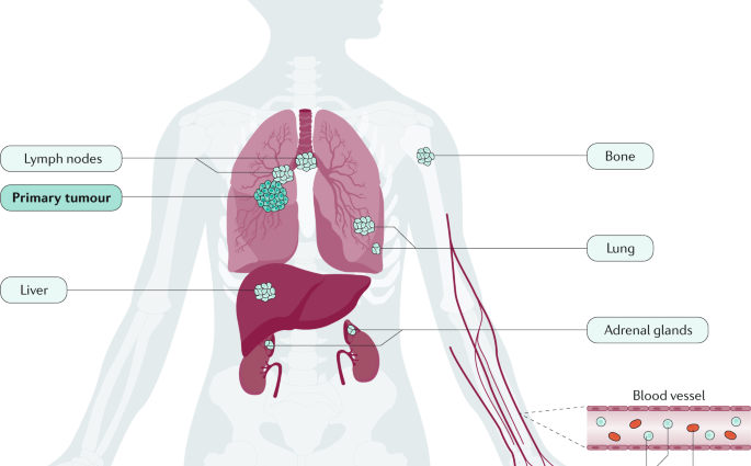 Lung cancer has the potential to become a chronic disease