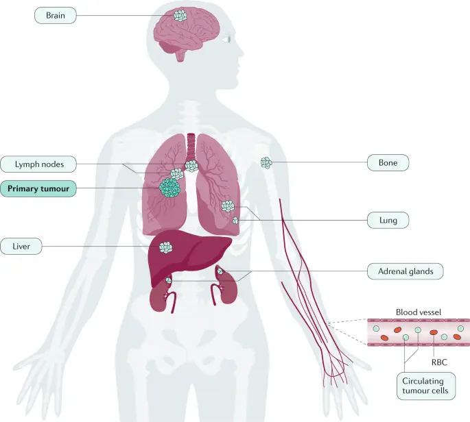 Lung cancer has the potential to become a chronic disease