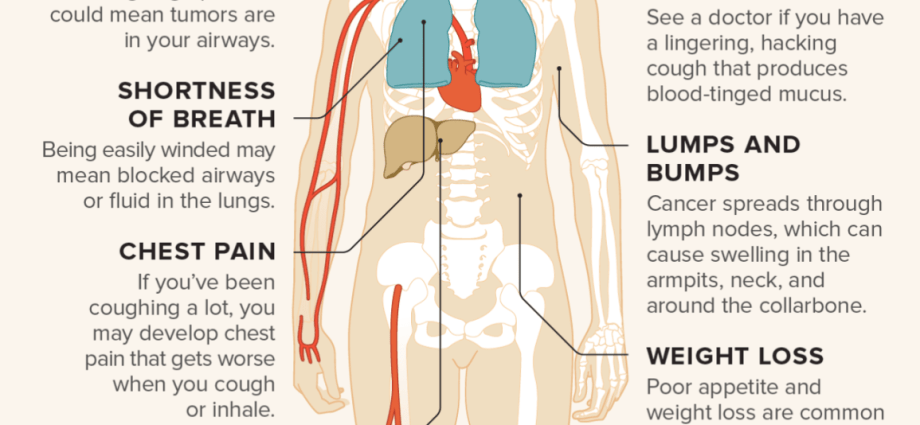 Lung cancer &#8211; symptoms, treatment, side effects. What do I need to know about lung cancer?