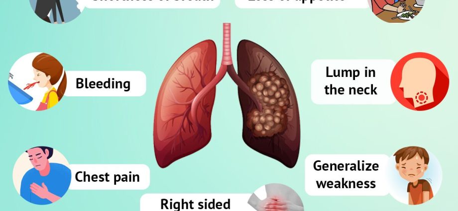 Lung cancer &#8211; what symptoms should you worry about? What symptoms should not be taken lightly?