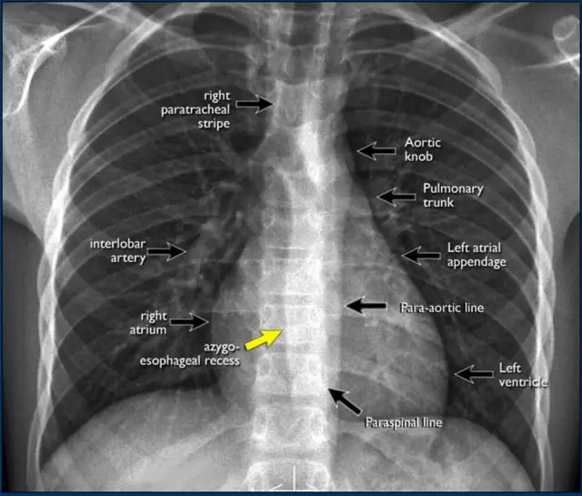 Lung X-ray &#8211; how to interpret the results?