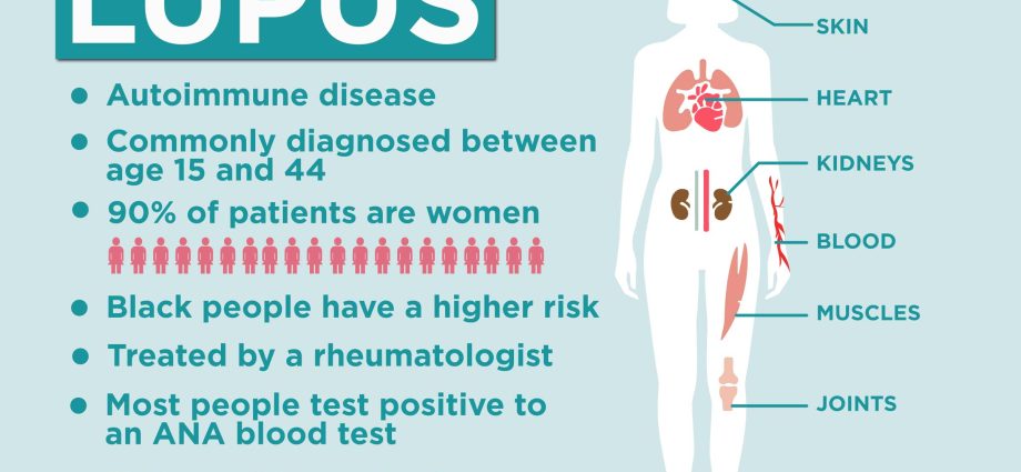 Lupus &#8211; symptoms, diagnosis, treatment