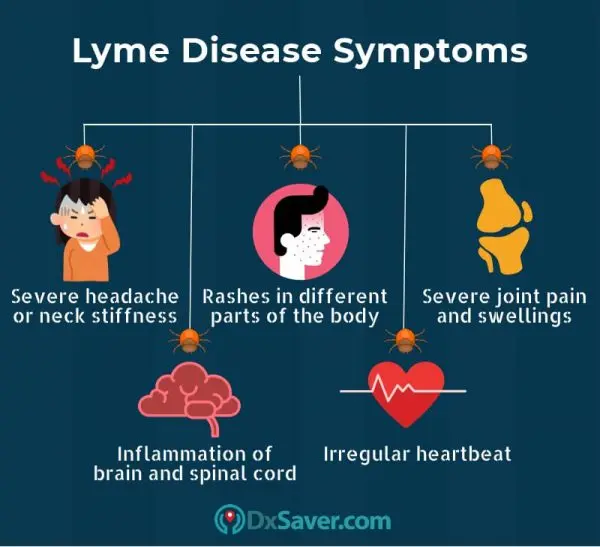 Lyme disease test &#8211; indications, course, price