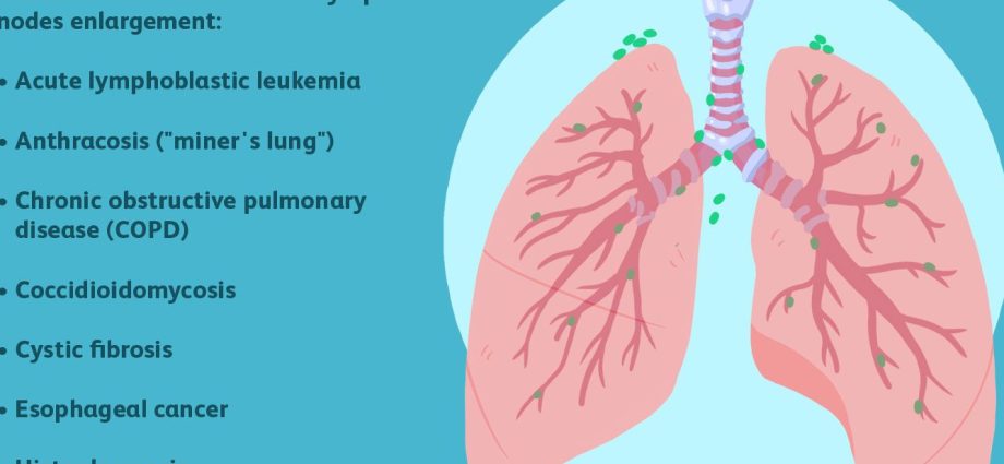 Lymphadenopathy &#8211; causes of enlarged lymph nodes. Cervical and mediastinal lymphadenopathy