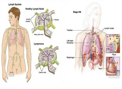 Lymphoma &#8211; an insidious tumor