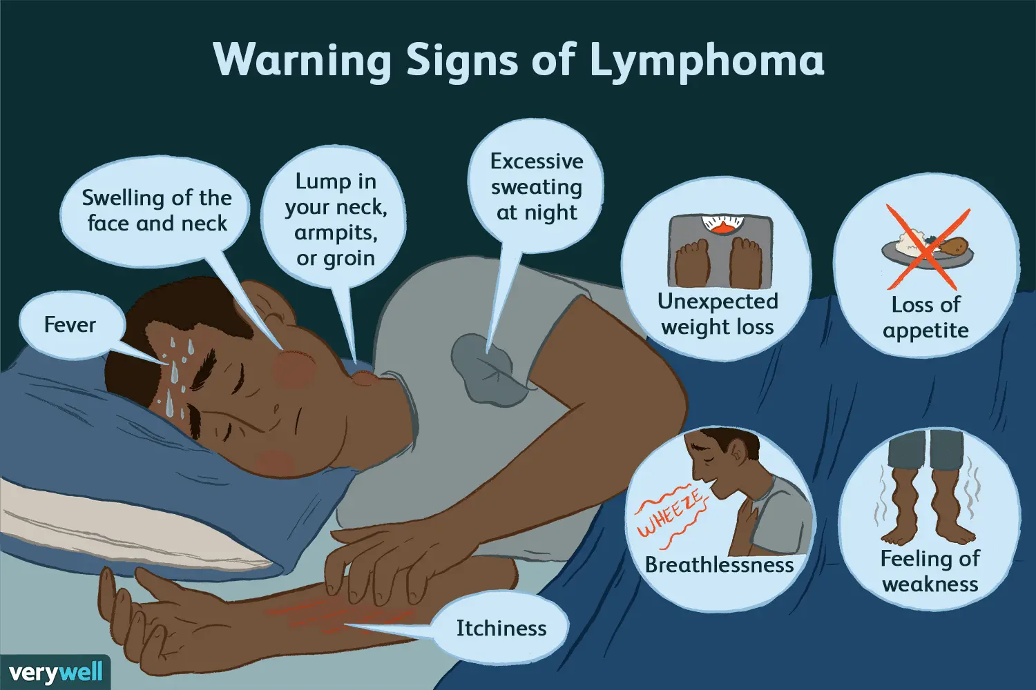 Lymphoma &#8211; Symptoms and Treatment