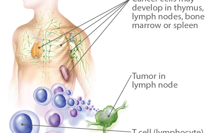 Lymphomas