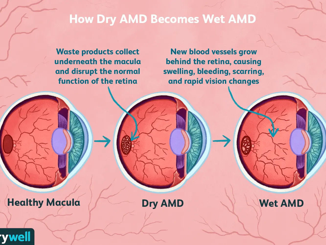 Macular degeneration &#8211; dry and wet form. What does the basic diagnostic test look like?