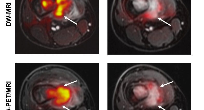 Magnetic resonance imaging in the treatment of cancer