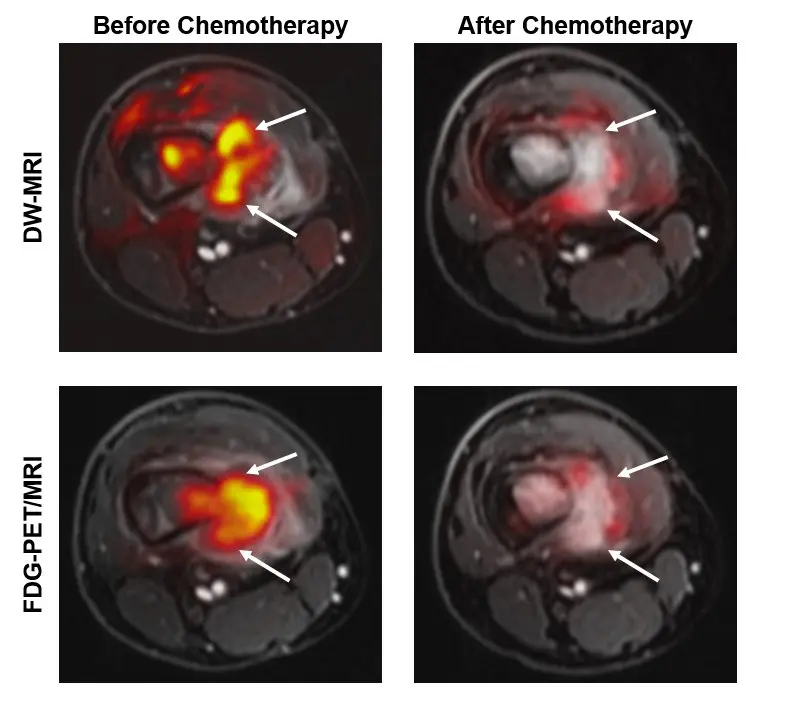 Magnetic resonance imaging in the treatment of cancer