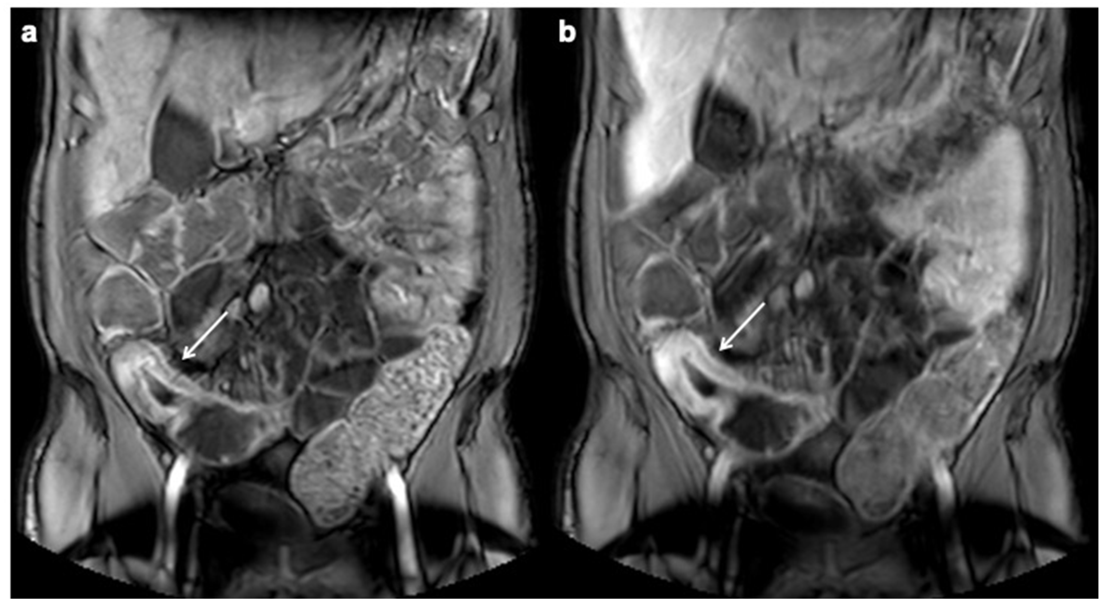 Magnetic Resonance Imaging Of The Abdominal Cavity Indications Contraindications And The 3464