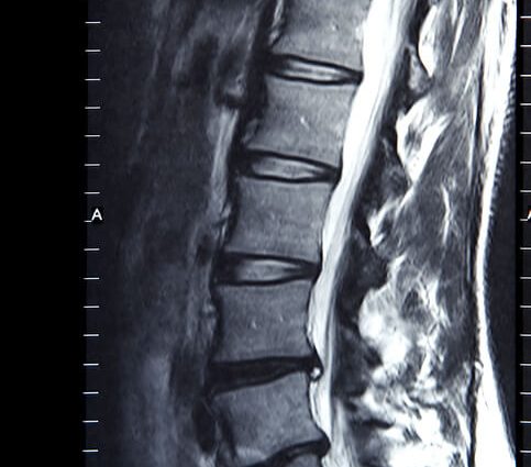 Magnetic resonance imaging of the spine &#8211; what does the examination look like?