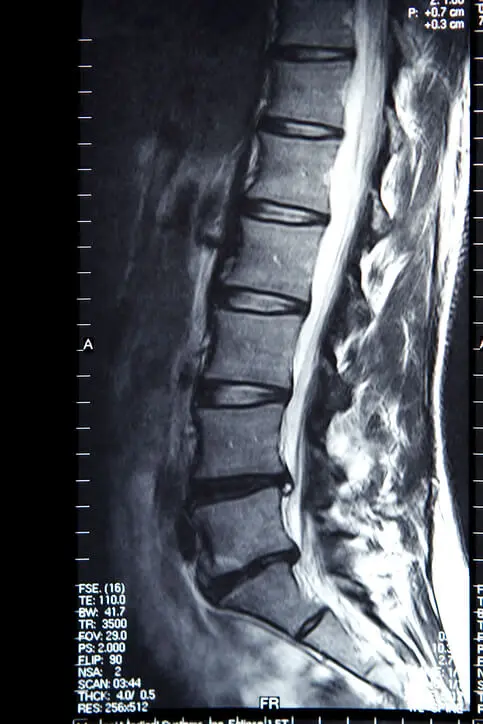 Magnetic resonance imaging of the spine &#8211; what does the examination look like?