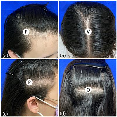 Male pattern baldness in women