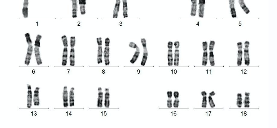 Male Y chromosome associated with risk of heart disease