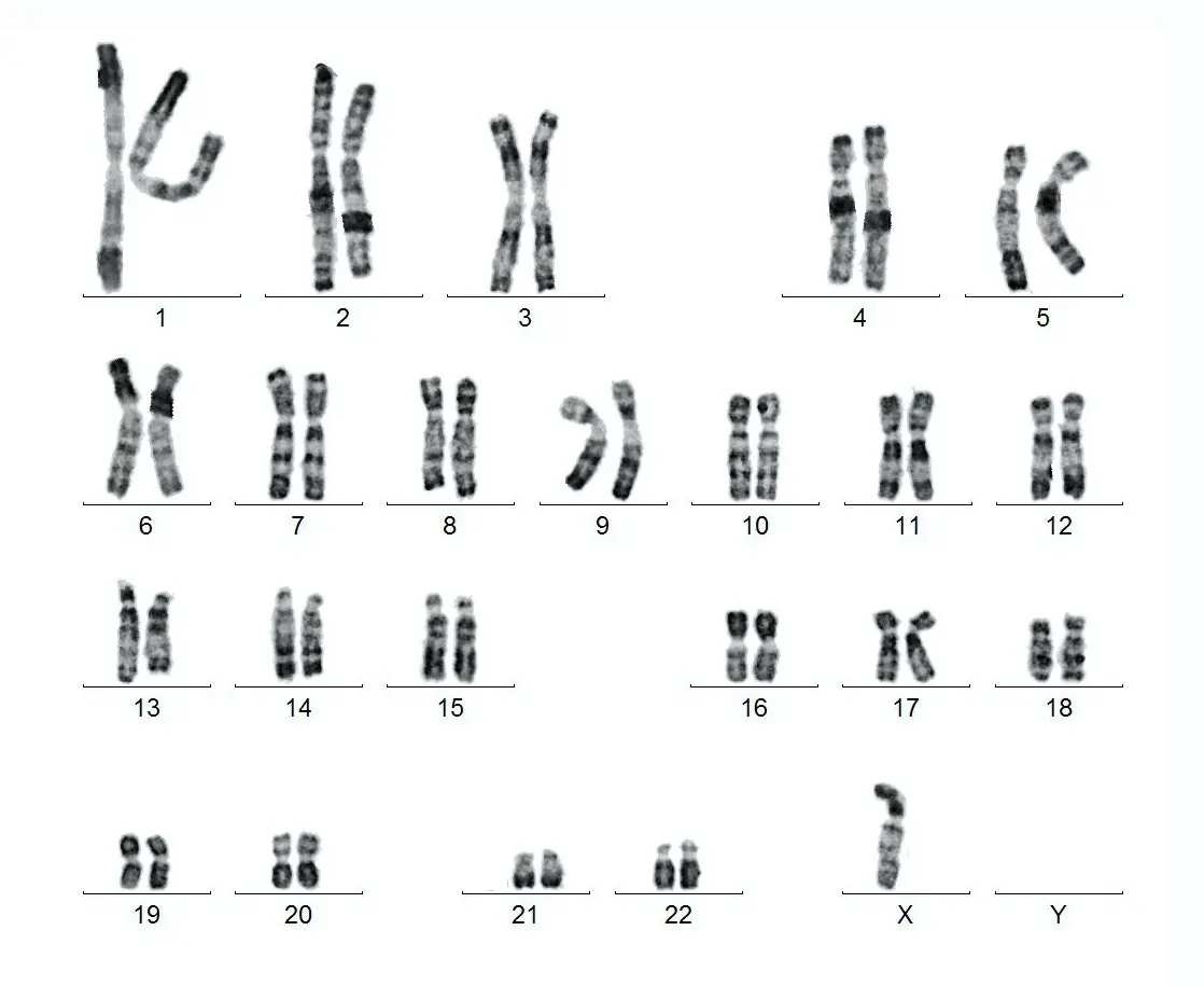 Male Y chromosome associated with risk of heart disease