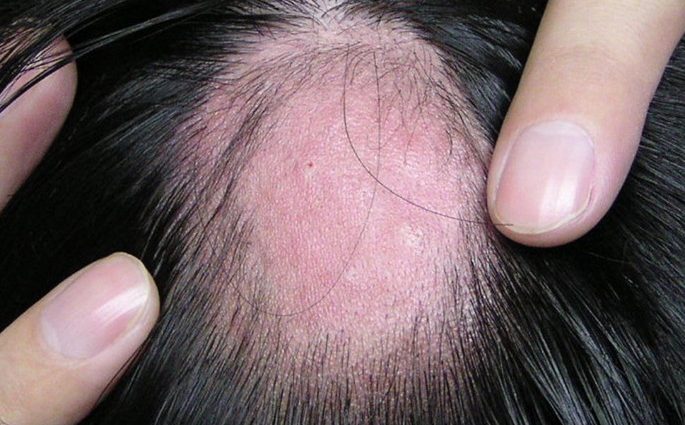 Malignant alopecia. Every day Justyna explains why she has no hair