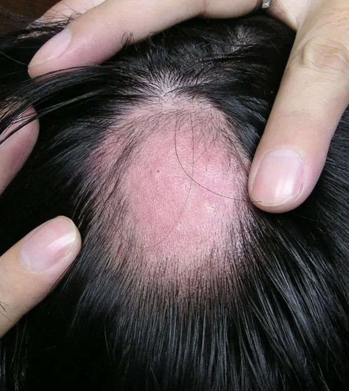 Malignant alopecia. Every day Justyna explains why she has no hair