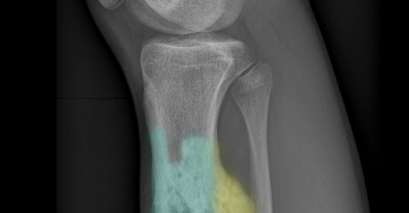 Malignant bone tumors &#8211; sarcomas, chondrosarcomas and tumors