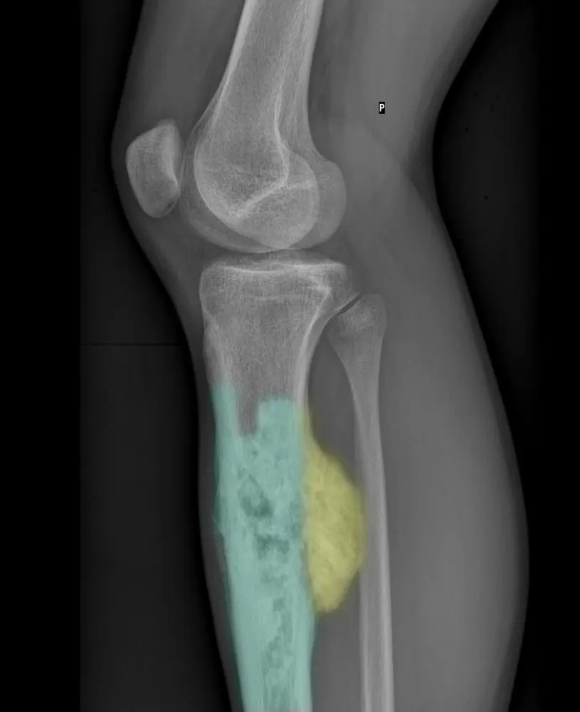 Malignant bone tumors &#8211; sarcomas, chondrosarcomas and tumors