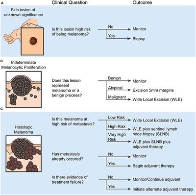 Malignant melanoma of the skin &#8211; symptoms, treatment, prognosis, metastases