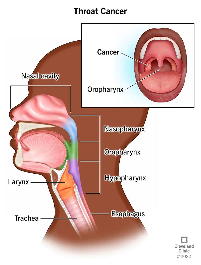 Malignant neoplasms of the throat &#8211; causes, symptoms and treatment