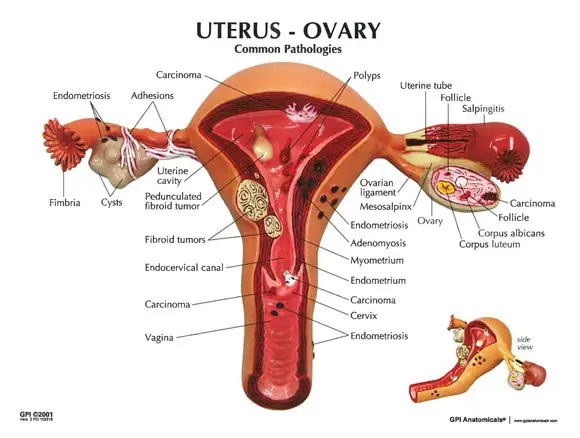 Malignant neoplasms of the uterus &#8211; causes, symptoms, treatment. Can they be prevented?