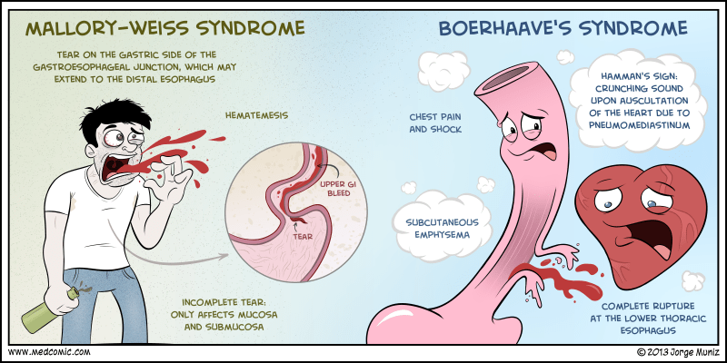 Mallory-Weiss syndrome