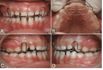 Malocclusion to be corrected by an orthodontic appliance