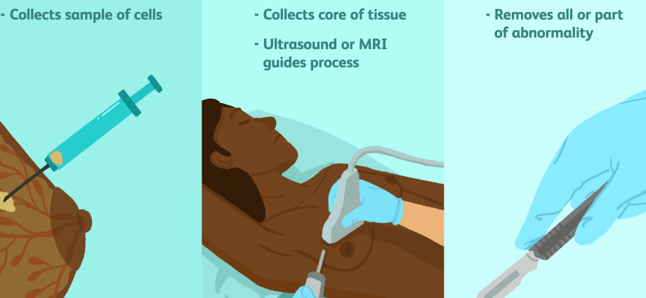 Mammographic biopsy &#8211; types of biopsy, course of the procedure, indications