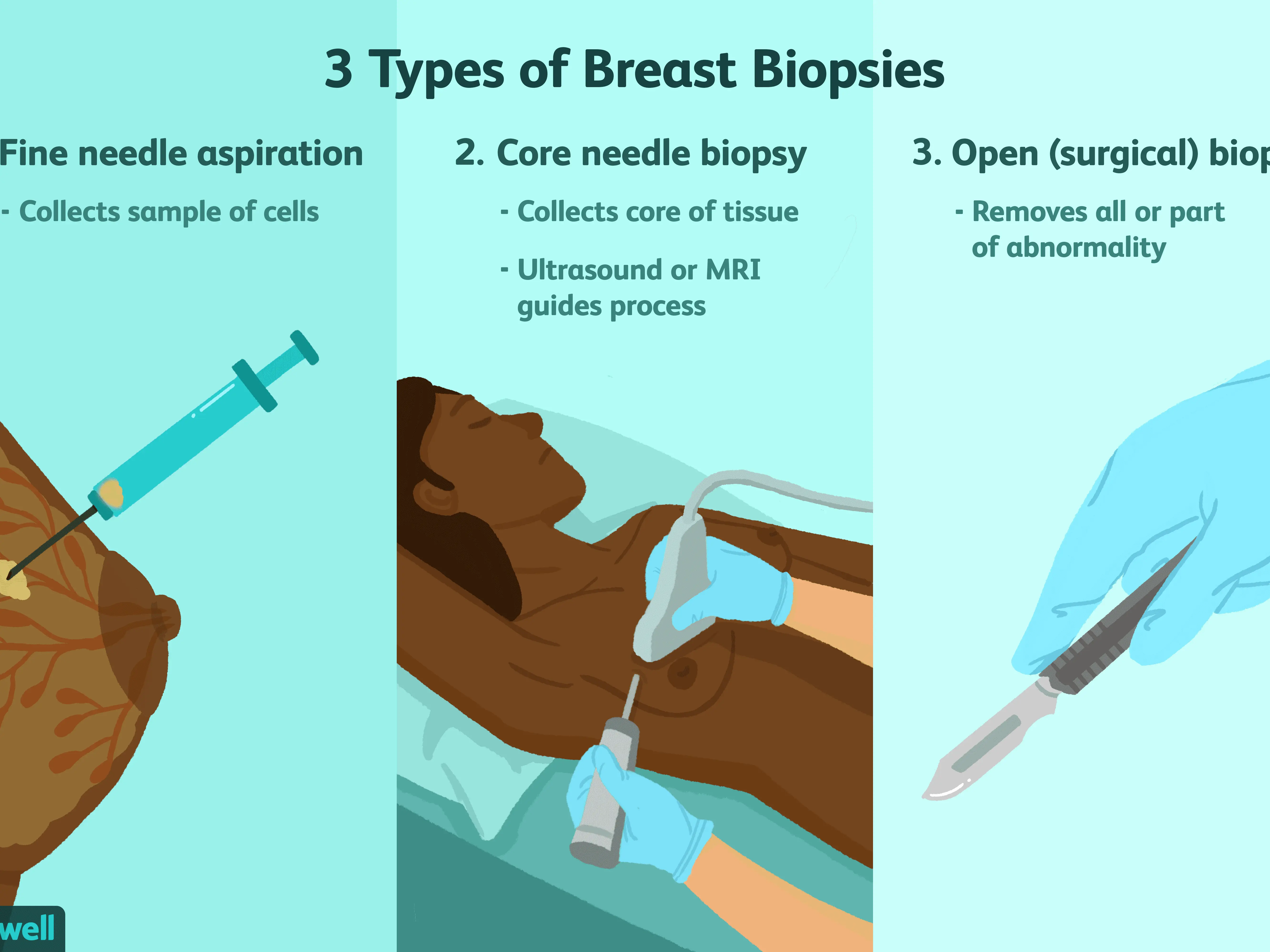 Mammographic biopsy &#8211; types of biopsy, course of the procedure, indications